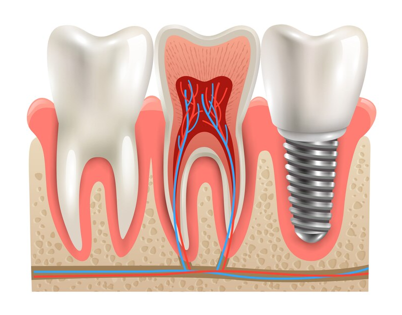 One-Day Dental Implants