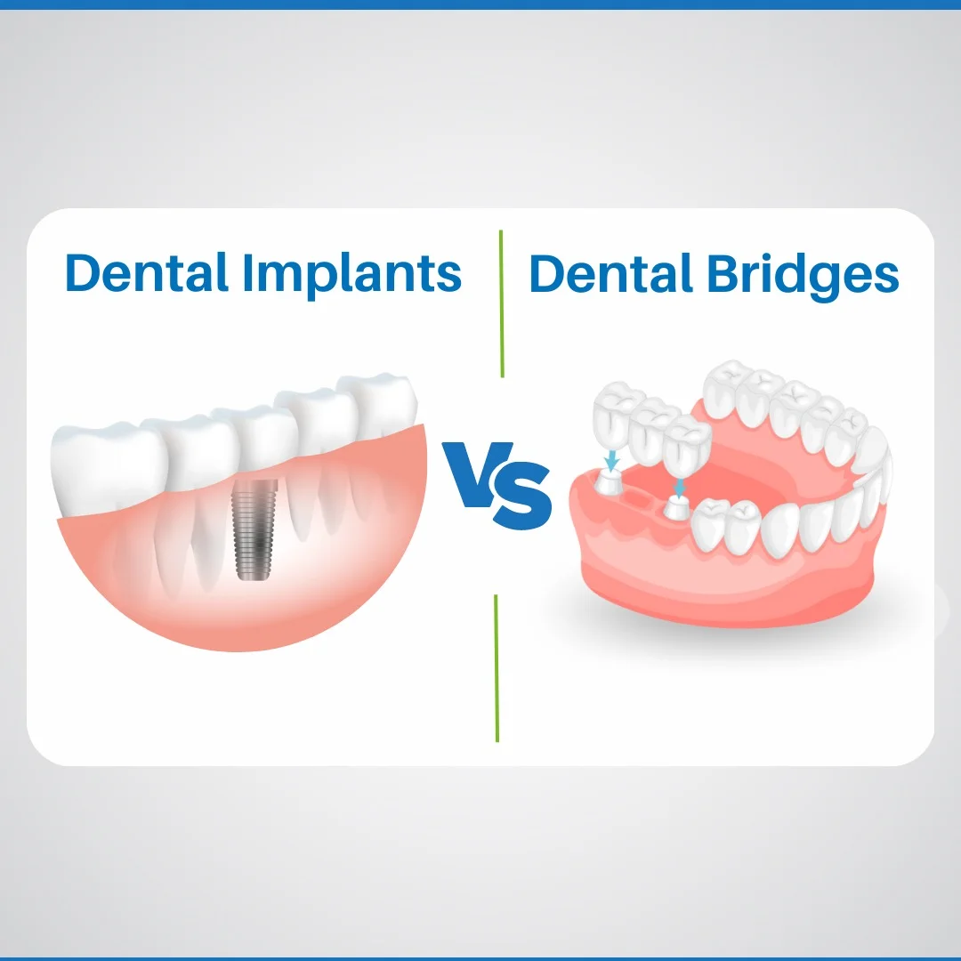 Single Tooth Replacement Options