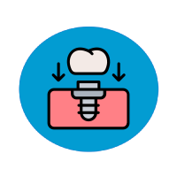 Full Arch Dental Implants